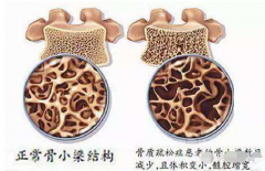 骨密度下降的危害日趋增加定期到医院用骨密度仪检测骨密度是相当必要