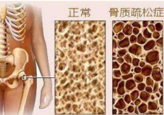 骨密度正常值是多少？超声骨密度仪生产厂家给你详细解答