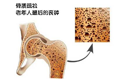 骨密度仪骨质疏松症