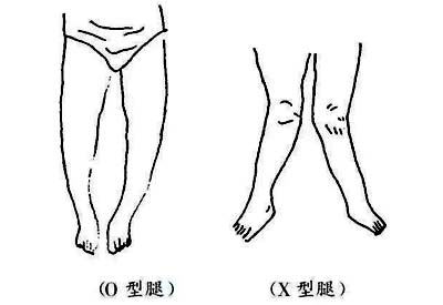 儿科便携式骨密度仪介绍早宝宝早期怎么有效的预防o型腿