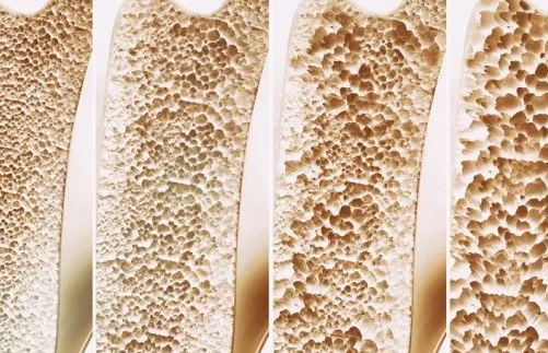 【超声骨密度仪】生产厂家国康提示老了与患骨质疏松相关的因素！