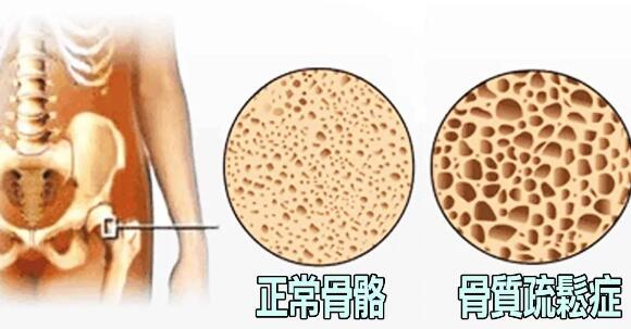 超声骨密度仪提示骨质疏松来的悄无声息测一测骨头的密度防患于未然