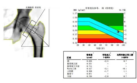 儿童骨密度检测仪厂家提问骨密度测量正常 身体会局部缺钙？