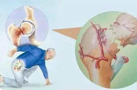 MQD-7000类型国产超声骨密度仪生产厂家提议骨质疏松应该增加骨密度吗？